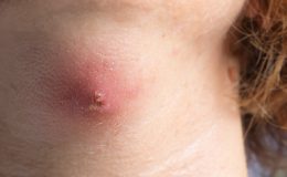 Çıban nasıl geçer, ne iyi gelir?