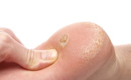 Siğil neden olur, nasıl geçer?