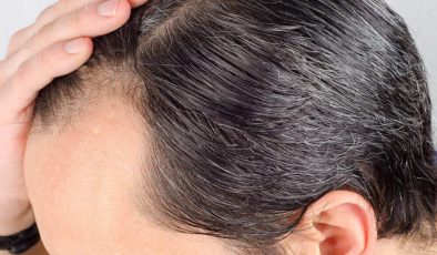 Kök Hücre Saç Ekimi